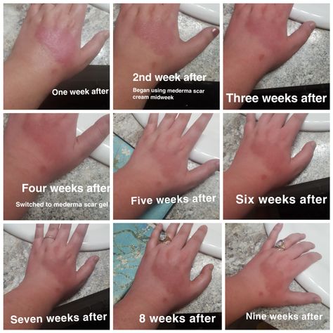 Second Degree Burn, Mederma Scar Cream, 3rd Degree Burns, Types Of Burns, Degree Burns, Scar Cream, Sunscreen Moisturizer, Coffee Routine, Hot Coffee