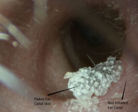 Itchy ears are a very common problem. For some people the problem is so bad that they stick various objects... Read the full article... Itchy Ears Causes, Itchy Inner Ear Relief, Itchy Ear Canal Remedies, Itchy Ears Remedies, Clogged Ears, Ear Diseases, Ear Problems, Inside Ear, Itchy Ears