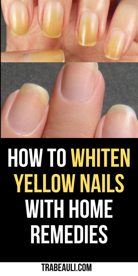 how to whiten yellow nails Stained Nails From Nail Polish, How To Whiten Toenails, How To Clean Yellow Nails, How To Whiten Yellow Nails, How To Whiten Your Nails, Yellow Natural Nails, Lemon Juice Nails, How To Whiten Nails, Baking Soda Nails