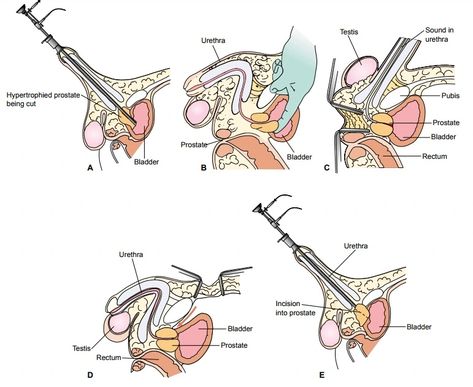 TURP (transurethral resection of the prostate) medical abbreviation Telescopic Resection of the Prostate involves coring out your prostate gland to improve the flow of urine, TURP is the most commonly performed operation to improve urine flow and most men get good relief of their symptoms. A bladder catheter is used for a short time after the operation to wash out blood clots. Prostate Gland, Patient Education, Medical, Education