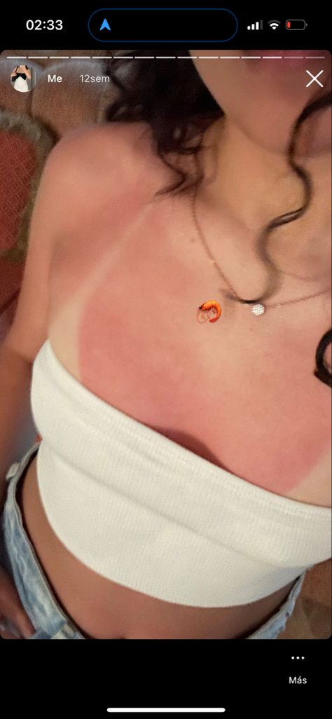 Cute Sunburn, Sunburn Makeup Look, Sunburn Pictures, Sunburn Aesthetic, Mexico Airport, Julie Davis, Trip Fits, Tan Aesthetic, Surviving Summer