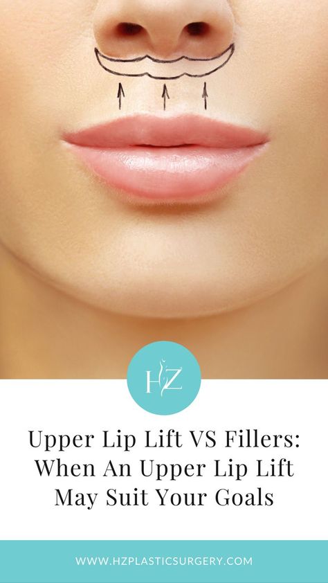 plastic surgery, upper lip lift, upper lip lift vs fillers Upper Lip Filler, Lip Lift Before And After, Lip Plastic Surgery, Lip Lift Surgery, Upper Lip Lift, Frank Tattoo, Lip Surgery, Lip Lift, Upper Lip Hair