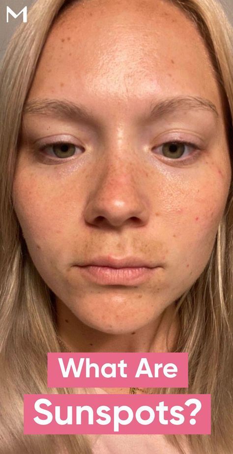 Are sunspots permanent or do they go away on their own? ✓ Learn all about areas of skin discoloration and how to remove them if they don't fade away. Sun Damage On Face, Sun Spots On Face, Sun Spots Removal, Sun Freckles, Black Spots On Face, Sunspots On Face, Blemish Remedies, Sun Protection Cream, Coconut Oil Skin Care