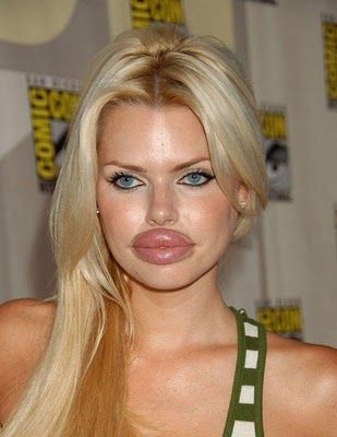 there are no words... and she probably couldn't say them if they were...Bet she wishes she did not have that lip enhancement surgery! Lip Plastic Surgery, Bad Plastic Surgeries, Plastic Surgery Fail, Plastic Surgery Gone Wrong, Lip Augmentation, Celebrity Plastic Surgery, Lip Enhancement, Duck Face, Lip Injections