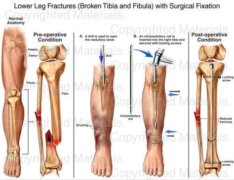 Lower Leg Fractures (Broken Tibia and Fibula) with Surgical Fixation Trimalleolar Fracture, Ankle Fracture Recovery, Broken Fibula, Fracture Photo, Leg Fracture, Broken Ankle Recovery, Ankle Recovery, Knee Replacement Recovery, Knee Pain Relief Exercises