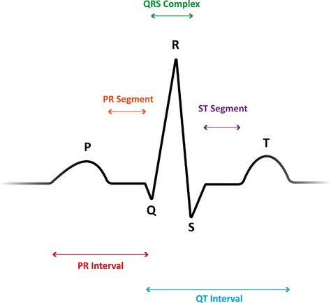 5-Lead ECG Interpretation, Electrocardiogram Tips for Nurses Cardiac Arrhythmias, Ekg Tech, Telemetry Nursing, Ekg Rhythms, Ekg Interpretation, Ecg Interpretation, Nursing Cheat, P Wave, Cardiac Nursing