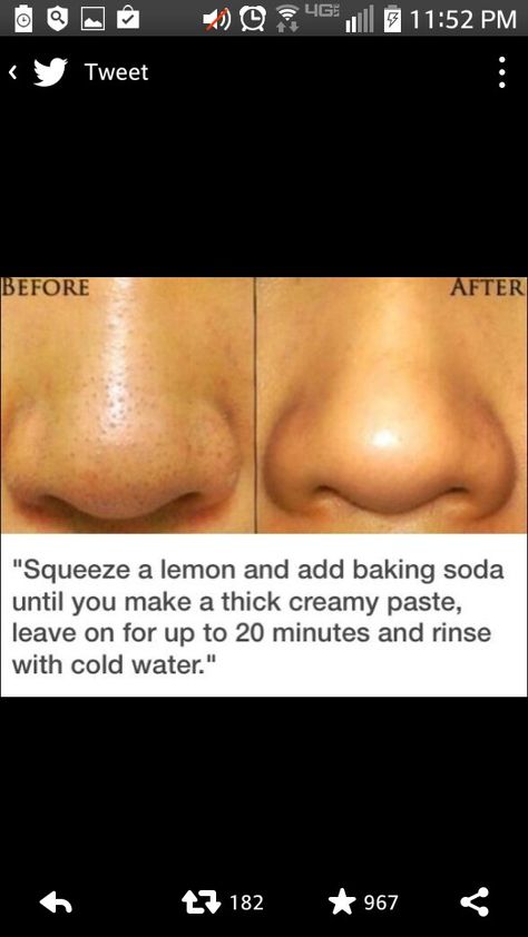 Black head remover diy Obličejové Masky, Exposed Skin Care, Blackhead Remover Diy, Diy Acne, Smink Inspiration, Skin Remedies, Skin Pores, Dr Oz, Lifestyle Tips