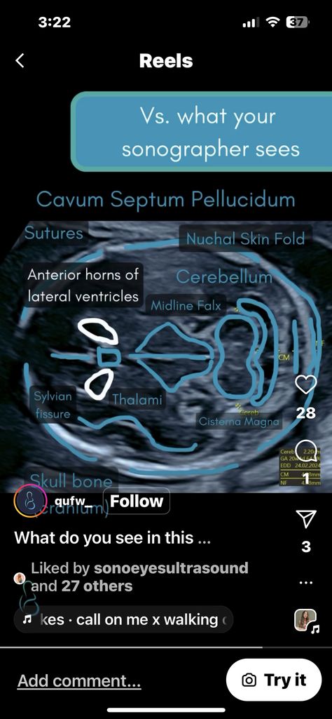 Ultrasound Student Notes, Uterus Ultrasound, Ultrasound Technician School, Ob Ultrasound, Veterinary Radiology, Ultrasound Student, Diagnostic Medical Sonography Student, Ultrasound School, Ultrasound Physics