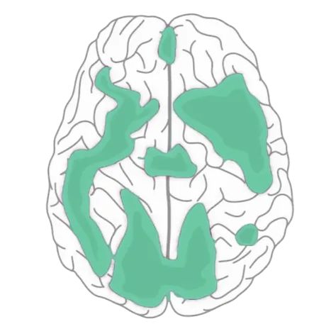 Tms Therapy, Transcranial Magnetic Stimulation, Shoulder Brace, Chemical Imbalance, Brain Stimulation, Talk Therapy, Every Day Book, Brain Activities, Clinical Trials