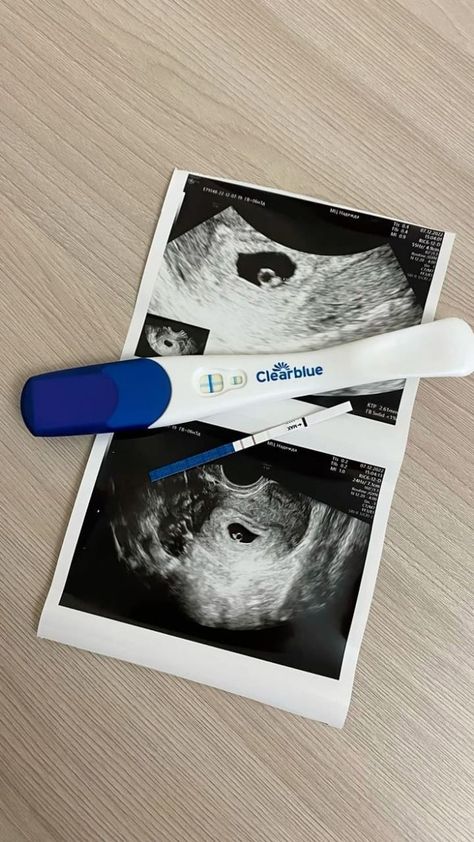 Pregnancy Ultrasound Photos, Ultrasound Picture Ideas, Baby Manifestation, Pregnancy Test Announcement, 2024 Baby Announcement, Pregnant Announcement, Announcement Pictures, Pregnancy Ultrasound, Cute Pregnancy Pictures