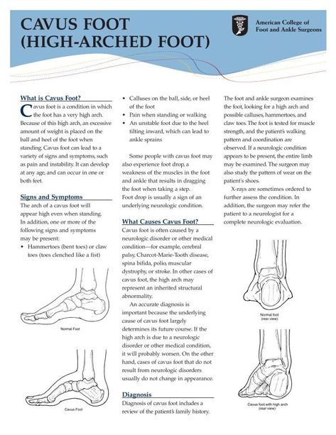 CAVUS FOOT (HIGH-ARCHED FOOT) High Arch Foot, Foot Exercises, High Arches, Gym Life, Read More, Arch, Gym