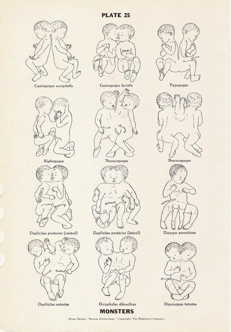 Conjoined Twins Drawing, Conjoined Twins Oc Drawing, Medical Diagrams, Siamese Twins, Conjoined Twins Art, Obscure Art, Conjoined Twins Oc, Fetal Position Drawing Reference, Human Placenta