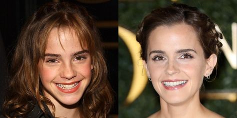 10 Celebrities with Veneers - Celebrities Who Had Major Teeth Transformations Celebrities With Veneers, Website For Anime, Celebrity Teeth, Shane Harper, Straight Smile, Cosmetic Dentistry Procedures, Faye Dunaway, Cher Lloyd, Dental Center