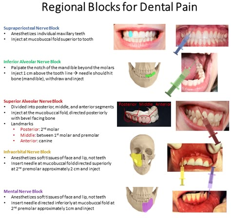 View in full resolution Dental Hygiene Local Anesthesia, Dental Local Anesthesia, Dental Xray Positioning, Local Anesthesia Dental Hygiene, Trigeminal Nerve Anatomy, Dental Abbreviations, Nerves Anatomy, Cranial Nerves Anatomy, Dental Assistant Study Guide