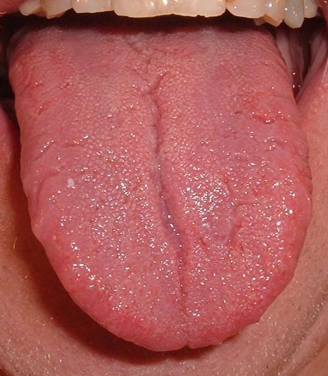 Cracked Tongue, Burning Tongue, Tongue Sores, Sensory System, Sick Remedies, Tongue Health, Homemade Beauty Tips, The Tongue, Holistic Medicine