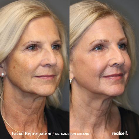 Upper Lip Wrinkles, Face Laser, Facial Procedure, Laser Facial, Laser Resurfacing, Lifting Facial, Facial Aesthetics, Facial Rejuvenation, Skin Resurfacing