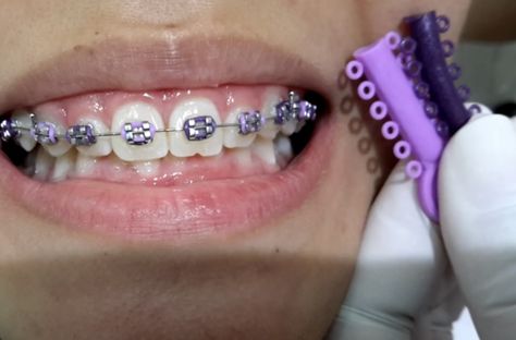 Violet Braces, Heart Shaped Braces, Light Purple Braces, Lilac Braces, Lavender Braces, Brackets Aesthetic, Perfect Teeth Braces, Purple Braces, Power Chain Braces