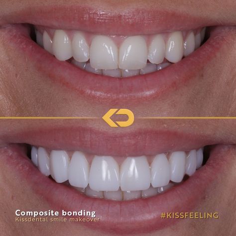 How incredible is this composite veneer makeover?! This patient was looking for a brighter more symmetrical smile. The Dr placed 10 composite edge bonds to complete the look. Book in for a FREE consultation at any of our clinics: 📍Manchester City centre 📍Flixton 📍Altrincham 📍Knutsford 📍Alderley Edge 📍Liverpool 📍Bramhall Head to kissdental.co.uk to get booked in Composite Edge Bonding Teeth, Composite Bonding Teeth Before And After, Edge Bonding Teeth, Composite Bonding Before And After, Teeth Bonding Before And After, Composite Teeth, Composite Bonding Teeth, Teeth Makeover, Cosmetic Bonding