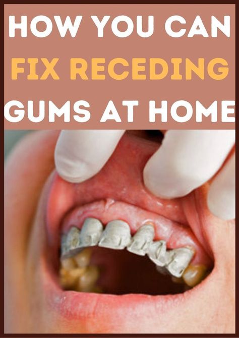 Rebuild Your Teeth and Gums And Get Rid of Tooth Decay. Do This 60 Seconds Dental Trick Before Going to Bed Tonight To Rebuild Your Teeth and Gums. Click the link and watch the full video. #gumcare #teethcare #teethcleaning #teethfixed #toothproblem #gumproblems Fix Receding Gums, Grow Back Receding Gums, Fix Teeth, Tooth Decay Remedies, Tooth Repair, Perfect Teeth, Tooth Pain, Teeth Health, Receding Gums