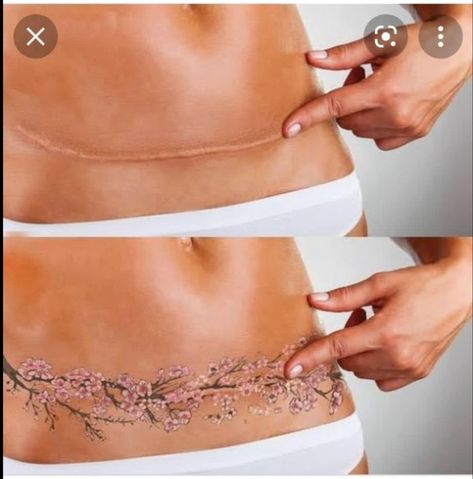 C Section Tattoo, Stretch Mark Tattoo, Abdomen Tattoo, Black Light Tattoo, Double Mastectomy, Tattoos To Cover Scars, Uv Tattoo, Tattoos Infinity, Scar Tattoo