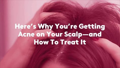 How to Get Rid of Scalp Acne Pimples On Scalp, Sores On Scalp, Painful Pimple, Scalp Acne, Pimple Causes, Exfoliating Scalp, Scalp Mask, Scalp Serum, How To Get Rid Of Pimples