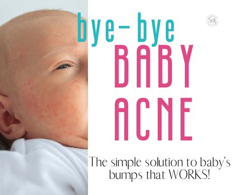 Bye, Bye Baby Acne Baby Acne Remedy, Newborn Acne, Baby Acne, Forehead Acne, Bye Bye Baby, Pimples Remedies, Natural Acne Remedies, Home Remedies For Acne, Acne Causes