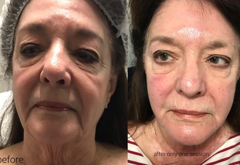 Morpheus8 Before and After - Capitis Medical & Aesthetics Morpheus 8 Before And After Face, Morpheus8 Before And After, Morpheus 8 Before And After, Morpheus 8, Medical Aesthetics, What A Girl Wants, Medical Aesthetic, After Photos, Skin Care Treatments