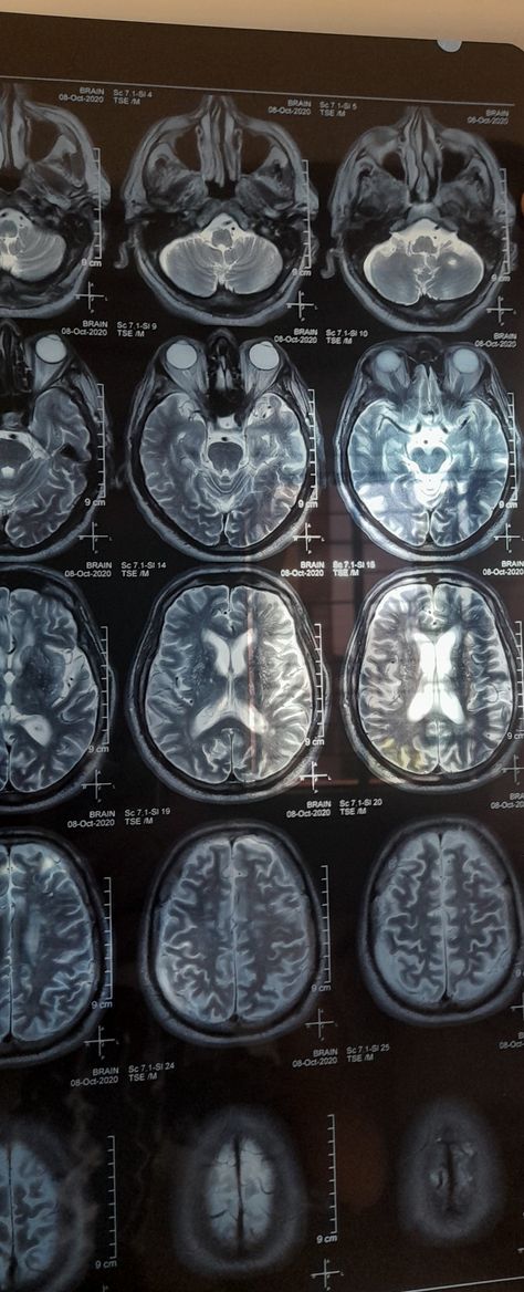 MRI of Brain:Age related changes of cerebral atrophy with deep white matter ischemia. Acute infarct in lt semiovale region. Neuroscientist Aesthetic, Mri Brain, Brain Surgeon, Aesthetic Doctor, Medical School Life, Basic Anatomy And Physiology, Radio Waves, Medical Student Motivation, Med School Motivation