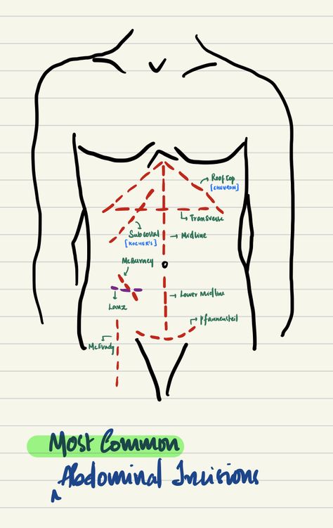 Abdominal Surgery incisions Abdominal Surgery, Surgery, Anatomy, Nursing, Disease, Medical, Quick Saves