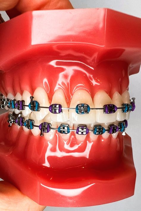 Dare to be different with teal braces. This teal and purple combination will make you want to smile! Explore playful braces color combinations that include teal. More on the website! Teal Braces, Light Blue Braces, Braces Colors Combinations, Blue Braces, Pink Braces, Red Braces, Silver Braces, Black Braces, Cute Braces Colors