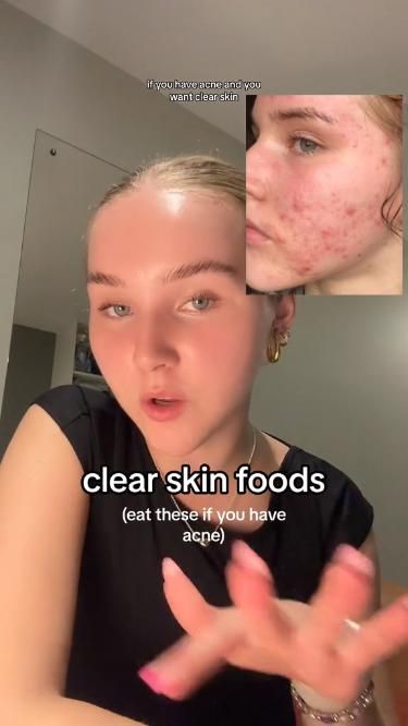 Eat these to clear acne 💪 Foods For Clear Skin, Skin Foods, Clear Skin Diet, Acne Diet, Acne Free Skin, Serious Skin Care, Acne Skincare Routine, Perfect Skin Care Routine, Clear Skin Tips