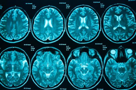 Scans for diagnosis | The Brain Tumour Charity Brain Scans, Cat Scan, Brain Scan, Mri Scan, Magnetic Resonance Imaging, Medical School Essentials, Ct Scan, Magnetic Resonance, Alternative Treatments