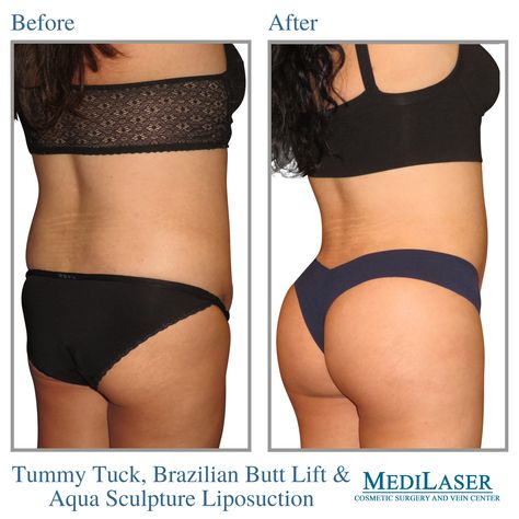 Mommy Makeover Surgery, Brazilian Buttlift, Arm Lift, Baby Fat, Mommy Makeover, Frisco Texas, Tummy Tucks, Let's Celebrate, Cosmetic Surgery