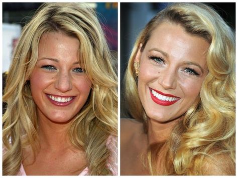 Blake Lively before and after porcelain veneers Celebrities With Veneers, Celebrity Teeth, Celebrity Smiles, Veneers Teeth, Porcelain Veneers, Perfect Teeth, Nice Teeth, Dental Veneers, Celebrities Before And After