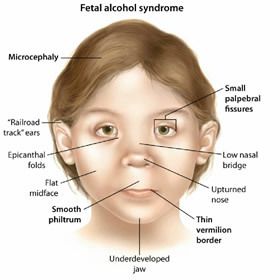 Fetal Alcohol Spectrum Disorder, Fetal Alcohol, Family Nurse Practitioner, Medical School Motivation, Medical School Studying, Medical School Essentials, Nursing Study, Medical Knowledge, Nclex