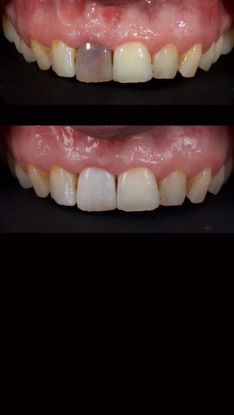 Dr. Jason Smithson showcases clinical examples that explain a more modern, minimally invasive approach to the discolored non-vital teeth using the “Modified Walking Bleach” approach. Read "Ultra-Conservative Management of the Discolored Tooth" today on Spear Digest. Baby Tooth Decay, Tooth Filling, Discolored Teeth, Whiten Your Teeth, Front Teeth, Gum Care, Healthy Meals To Cook, Oral Health Care, Tooth Decay