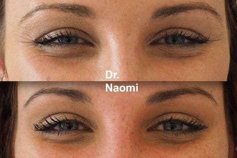 Fillers vs. Thread Lift: Which Is Better for Facial Rejuvenation? - Costhetics Facial Balancing Filler Before And After, Facial Thread Lift, Eye Trough Filler, Tear Through Eye Filler, Pdo Thread Lift Before And After Face, Pdo Thread Lift Before And After Neck, Thread Lift Face, Face Threading, Brow Filler