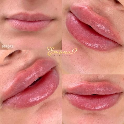 Can’t hear you over the volume of these lips 😍 Beautiful before and after! 👄 Call/text to book your lip filler appointment today! (310)878-4321 📍Beverly Hills #lipfillerbeforeandafter #beforeandafterlipfillers #russianliptechnique #lipfillers Lip Filler, Lip Fillers, Beverly Hills, Medical, Lips, Quick Saves