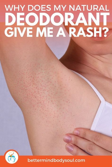 Switching to natural products like deodorants is a bit of a transition process. Especially since some can cause skin irritations and rashes. But it’s usually not the fault of the new natural product. There’s a number of different factors that come into play before landing on allergies. This article touches on all the points to look at when dealing with rashes form natural deodorants, so have a read and see what applies to you and what you can do about it.  #AllNatural  #organic Deodorant Alternatives, Armpit Rash, Rashes Remedies, Rash Causes, Underarm Deodorant, Deodorant Recipes, Underarm Odor, Home Remedies For Skin, Diy Deodorant