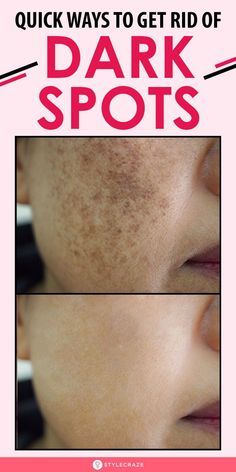 Age Spots On Face, Brown Spots On Skin, Spots On Legs, Dark Spots On Face, Brown Spots Removal, Brown Spots On Face, Dark Spots On Skin, Skin Spots, Lighten Dark Spots