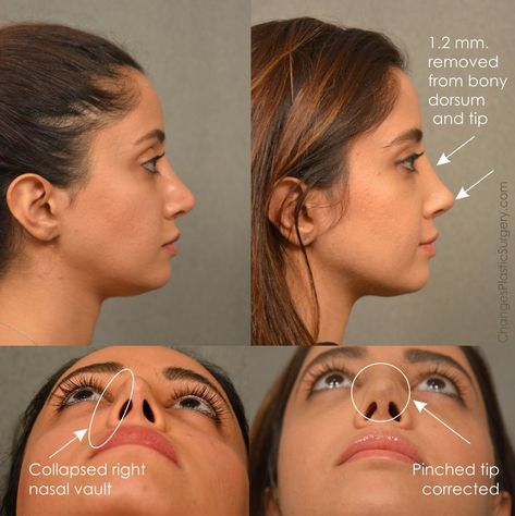 Revision rhinoplasty corrections to dorsum and collapsed right nostril. #rhinoplasty #changesplasticsurgery Rhinoplasty Reference, Rhinoplasty Before After, Rhinoplasty Recovery Timeline, Nose Job Before And After, Revision Rhinoplasty, Nonsurgical Nose Job, Rhinoplasty Recovery, Nose Surgery Rhinoplasty, Nose Jobs