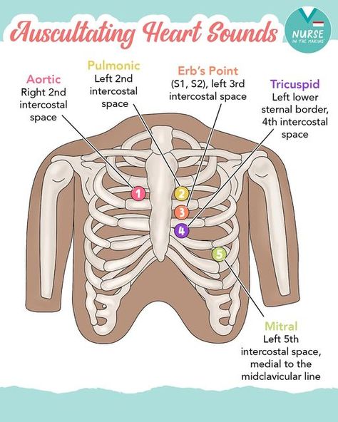 Kristine Tuttle on Instagram: "-Auscultating Heart Sounds- 1️⃣Aortic: Right 2nd intercostal space 2️⃣Pulmonic: Left 2nd intercostal space 3️⃣Erb’s Point: (S1, S2), Left 3rd intercostal space 4️⃣Tricuspid: Left lower sternal border, 4th intercostal space 5️⃣Mitral: Left 5th intercostal space, medial to the midclavicular line It can be tricky doing your first few head-to-toe assessments in a clinical setting. The Complete Nursing School Bundle includes information presented in many different ways: using comparison charts, memory tricks, mnemonics & illustrations designed to help you truly grasp & learn the information! 🫀What mnemonic do you use to remember the areas of listening to the heart? #nursingschool #nursingnotes #auscultation #heartsounds #nurseshelpingnurses" S1 And S2 Heart Sounds Nursing, Heart Auscultation Points, Heart Assessment Nursing, S1 S2 Heart Sounds, Apical Pulse Location, Lung Auscultation Landmarks, Cardiac Assessment Nursing, Central Line Nursing, Auscultation Heart