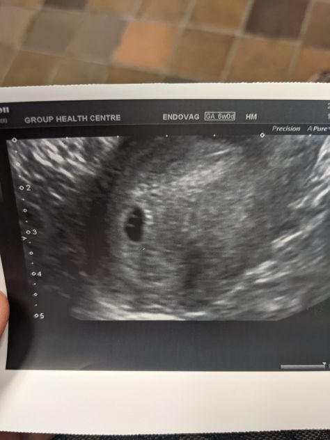 Pregnant for my second time, so so so excited to meet the little bean...or possibly BEANS. Mommy and Daddy love you SO much already. First Ultrasound, Body Image Art, Ultrasound Tech, Circle Mehndi Designs, Best Poses For Pictures, Pregnant Belly, Rainbow Baby, Ultrasound, Poses For Pictures