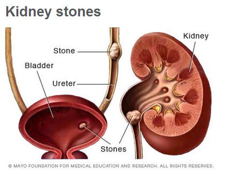 Kidney stones illustration Renal Calculi, Prostate Surgery, Creatinine Levels, Chest Congestion, Mayo Clinic, Urinary Tract, Disease, Medical, Stone