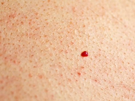 Liver Skin Spots, Red Dots On Skin, Cherry Angioma Removal, Skin Conditions Pictures, Red Skin Spots, Cherry Angioma, Blood Blister, Red Moles, Coconut Health