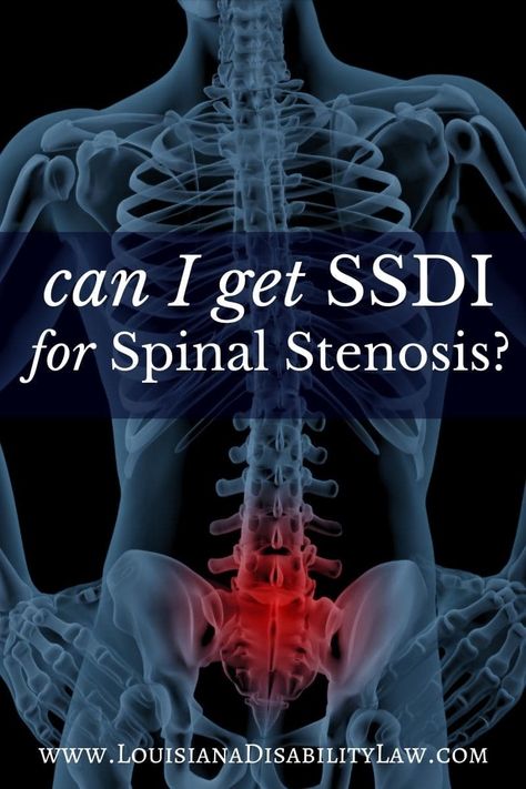 Narrowing Of The Spine, Stenosis Of The Spine, Stenosis Exercises, Spinal Degeneration, Spine Problems, Spinal Decompression, Neck Surgery, Spine Health, Nerve Pain Relief