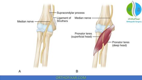 Pronator Teres Syndrome Pronator Teres, Nerve Anatomy, Forearm Muscles, Median Nerve, Orthopedic Surgery, Carpal Tunnel, Sports Medicine, Success Rate, Nerve