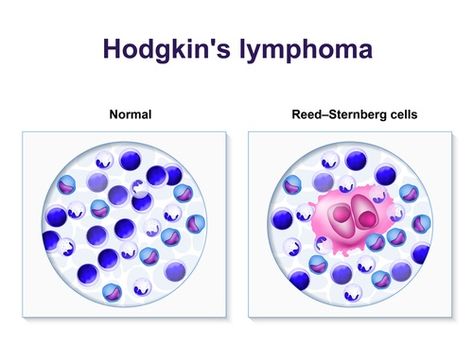 Patient Illustration, Human Cells, White Blood, Health Planner, Lymph Nodes, Young Living Oils, Natural Therapy, Types Of Cancers, Blood Cells