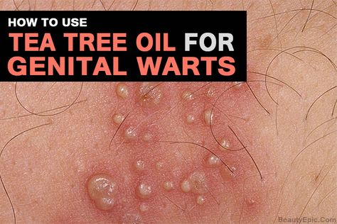 Genital warts are caused by human papilloma virus which is transmitted sexually & causes itches. Here we explain using of Tea Tree Oil for Genital Warts Tree Oil Benefits, Tea Tree Oil Benefits, Types Of Warts, Tea Tree Oil Face, Warts Remedy, Tea Tree Oil For Acne, Human Body Systems, After Surgery, Oil Benefits