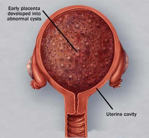 Molar pregnancy, diagram. Molar Pregnancy, Ob Nursing, Nurse Stuff, Cavities, Surgery, Nursing, My Baby, Map, Education